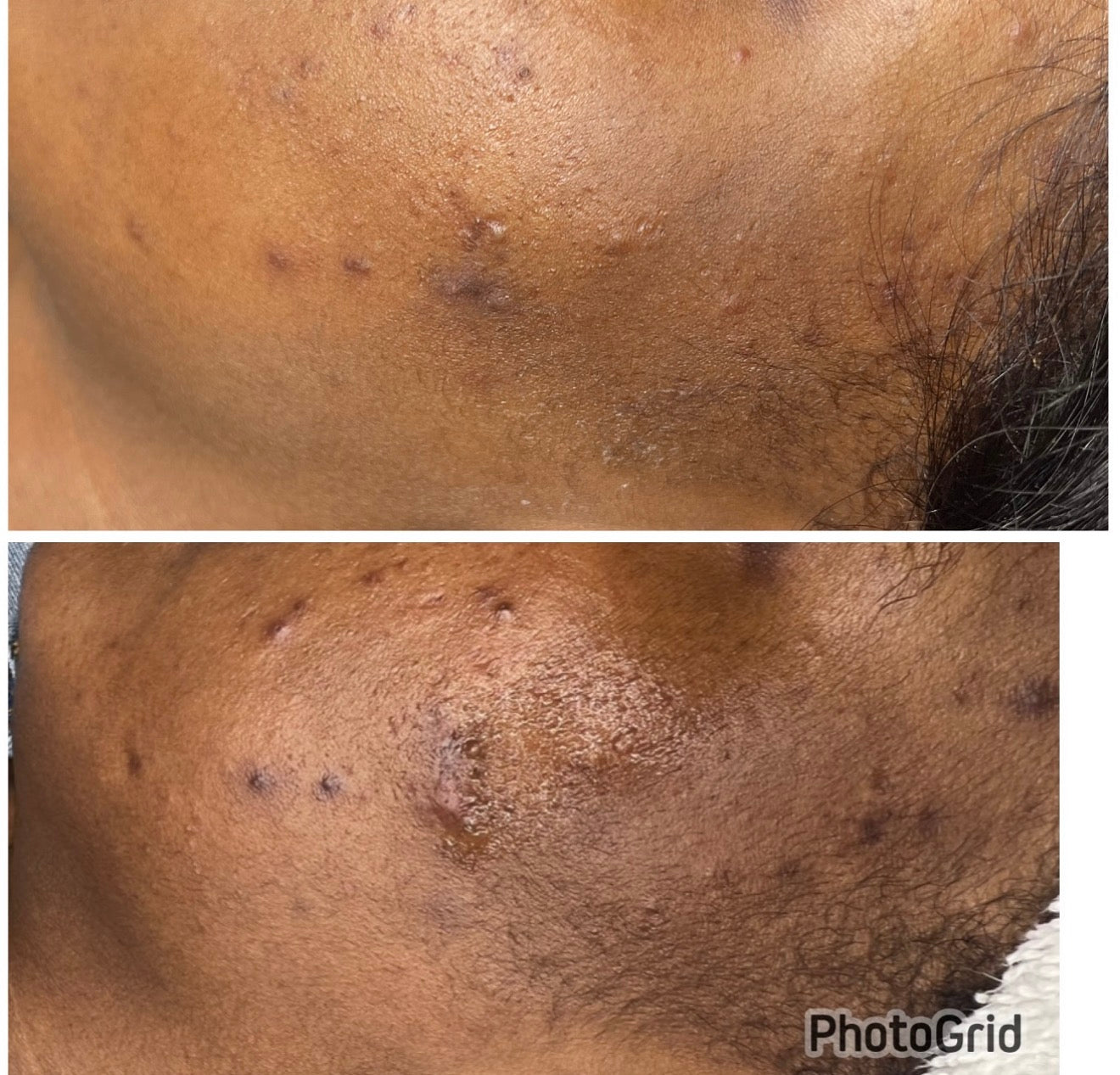 Activated Charcoal/Acne  Kit